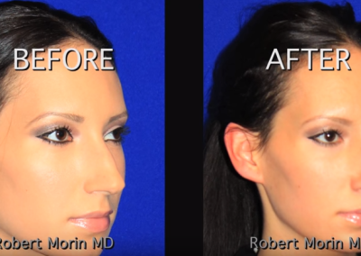 Rhinoplasty NYC Before and After